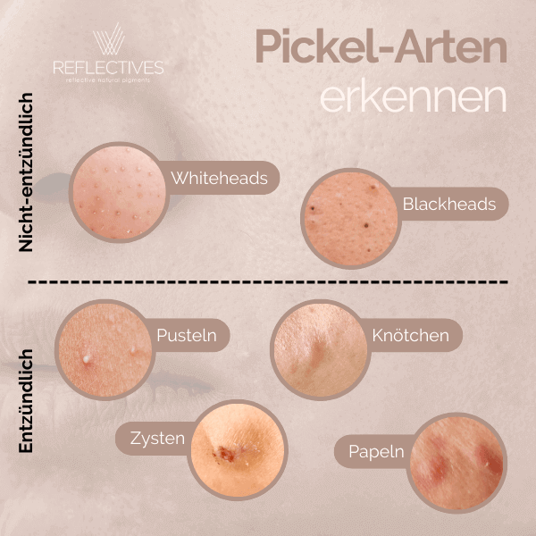 Pickel-Arten (Arten von Hautunreinheiten) in einer Infografik dargestellt.